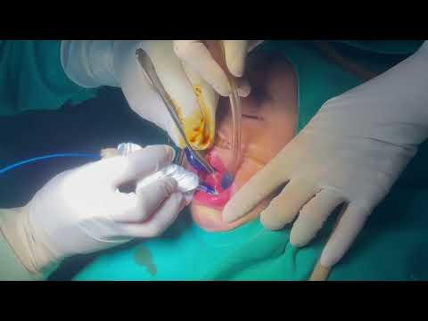 PHẪU THUẬT CẮT PHANH/THẮNG LƯỠI: KHÔNG ĐAU - KHÔNG CHẢY MÁU - PHỤC HỒI NHANH - BVĐK HẬU LỘC
