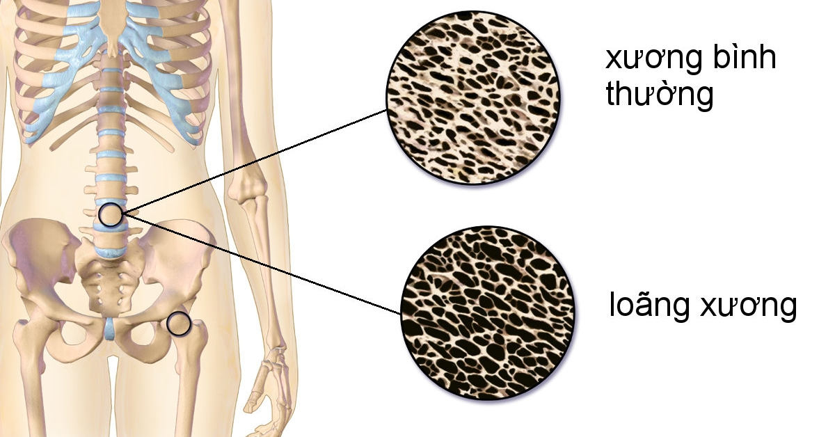 Hình ảnh loãng xương