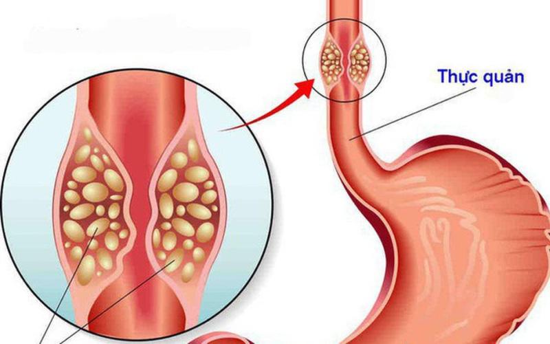 Triệu chứng hẹp thực quản: Đừng chủ quan khi thường xuyên nuốt nghẹn