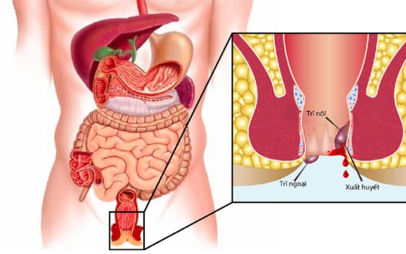 6 sai lầm khiến nhiều người điều trị trĩ thất bại
