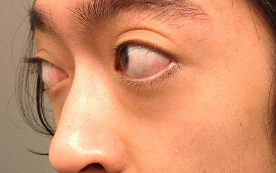 Lồi mắt Basedow cần làm gì?