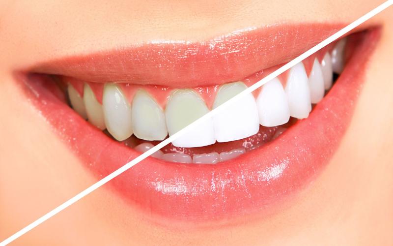 Thói quen xấu làm hại men răng thường gặp