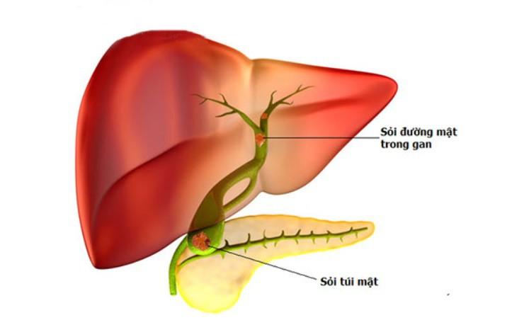 Sỏi đường mật trong gan: Vì sao dễ tái phát và gây biến chứng?